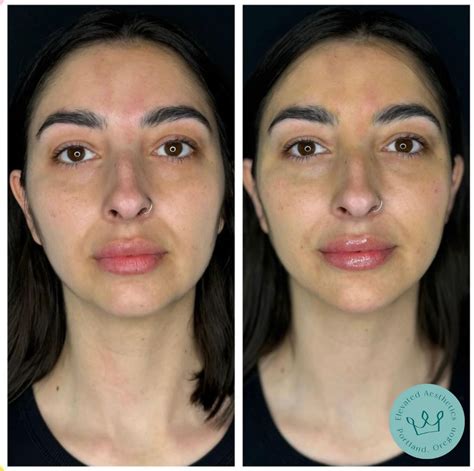 Collagen Biostimulators - Elevated Aesthetics