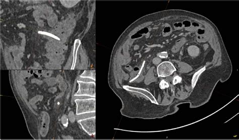 Image result for Exploding Colon