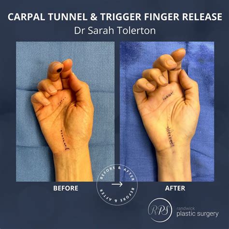 Hand Surgery Gallery - Randwick Plastic Surgery