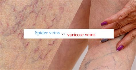Difference between varicose veins and Spider Veins