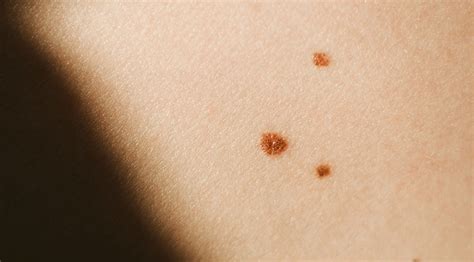 Melanoma skin cancer pictures early stages | Symptoms and pictures