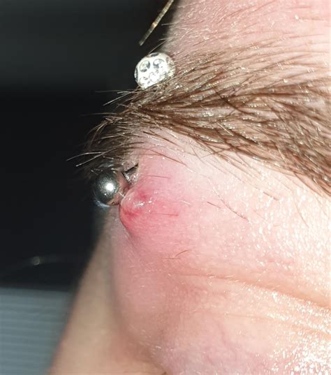 Eyebrow Piercing Infection Signs