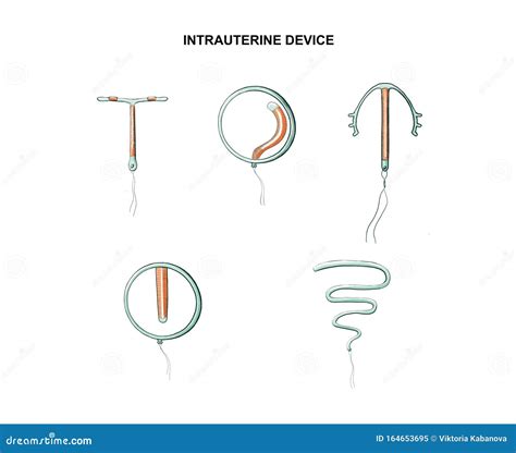 Intrauterine device, IUD stock illustration. Illustration of condom - 164653695