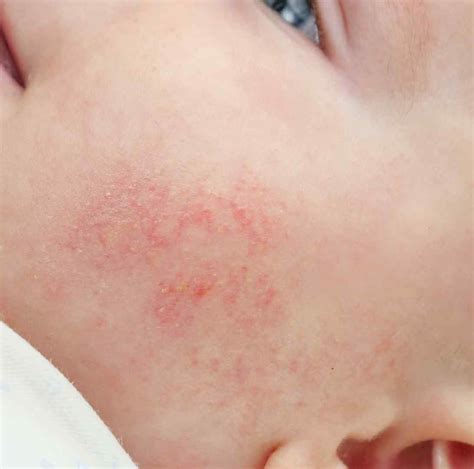 Baby Acne On Chest And Arms at Michelle Gilbert blog