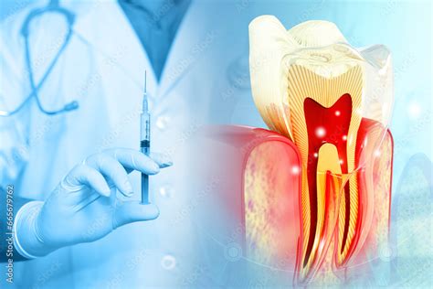 Local Anesthesia Injection 的图像结果