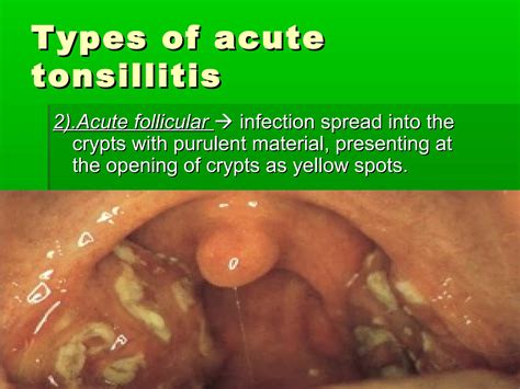 Acute & chronic tonsillitis and their management | PPT