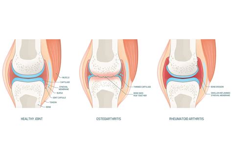 Rheumatoid Arthritis vs Osteoarthritis: What's the Difference?