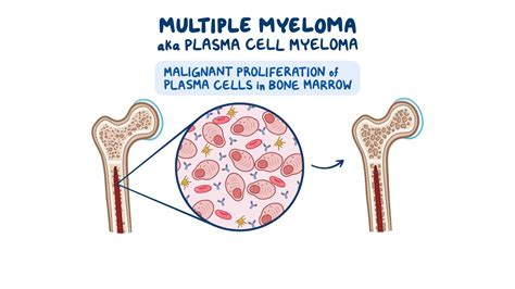 Plasma Cell In Multiple Myeloma