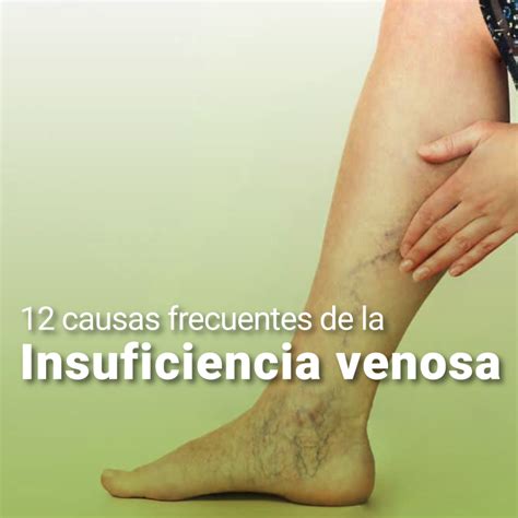 12 causas frecuentes de la Insuficiencia venosa - Diagnosticar IPS, Unidad de Diagnóstico por ...