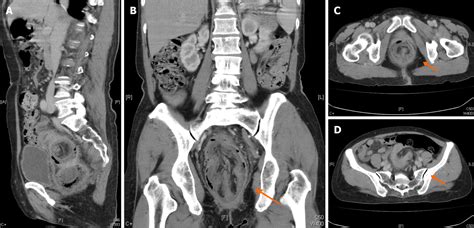 Adult sigmoid intussusception resembling rectal prolapse: A case report