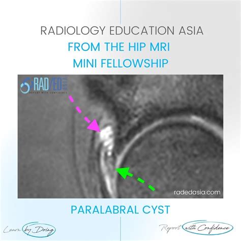 HIP PARALABRAL CYST MRI LABRUM TEAR DEGENERATION - Radedasia