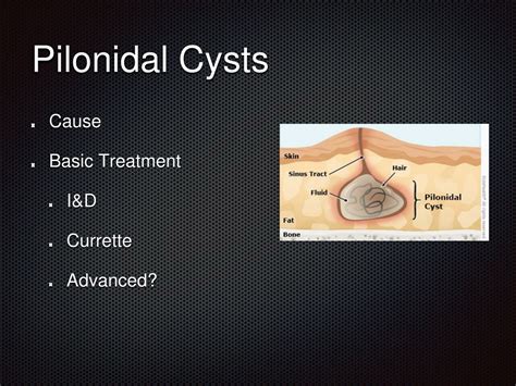 Pilonidal cyst lancing procedure. Pilonidal Cyst Surgery: A Comprehensive Guide to Treatment ...