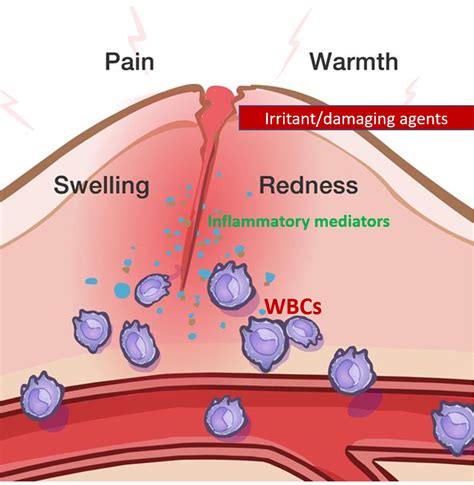 Image result for Inflammation Reaction