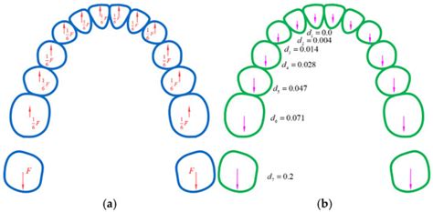Force-Driven Model for Automated Clear Aligner Staging Design Based on ...