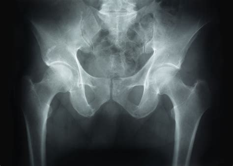 Hip Bone On Bone X Ray at Nicholas Petterson blog