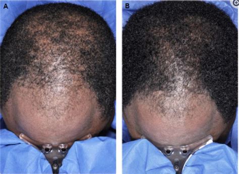 Rogaine for Men: Does it Really Work and What Makes it Manly?