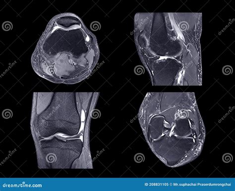 Mri Of Knee