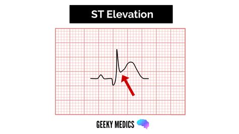 Abnormal Ecg Examples