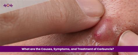 Image result for Removing Carbuncle