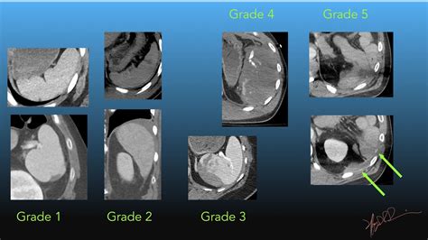 AAST Spleen Injury Scale 2018 revision | UW Emergency Radiology