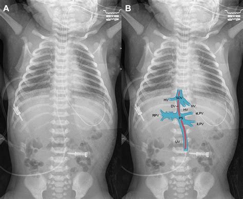 How To Insert Umbilical Venous Catheter at Tayla Currey blog
