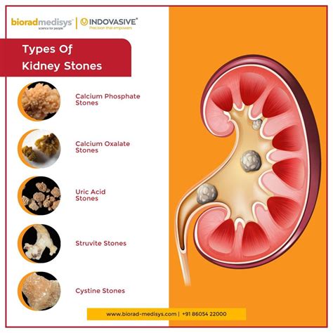 Types of kidney stones chart comparison and treatment – Artofit