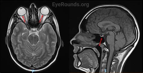 File:EyeRounds Case 341, Fig1-MRI-brain-without-contrast-LRG.jpg - NC ...
