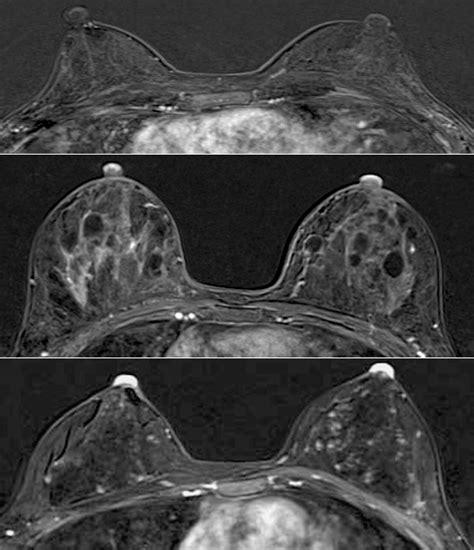 Paget Disease of the Breast: Mammographic, US, and MR Imaging Findings ...