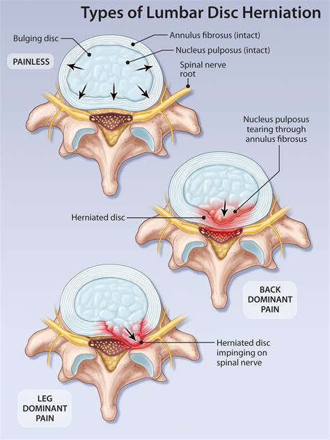 Lumbar Disc Herniation Yoga at Troy Bellows blog