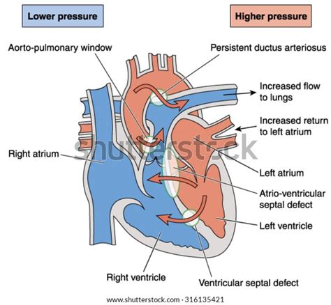Image result for Heart Abnormal Development