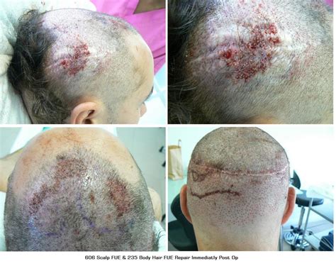 International Hair Loss Forum - Dr Bisanga (BHR Clinic) Reparation FUE ...