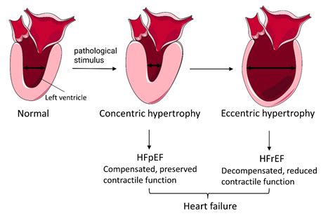 Global Profile of tRNA-Derived Small RNAs in Pathological Cardiac ...