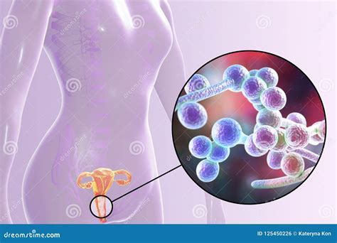 Vaginal Thrush, Female Candidiasis Stock Illustration - Illustration of ...