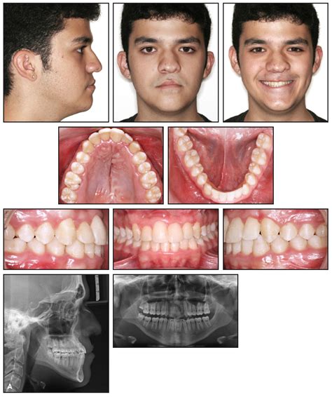Image result for Crossbite Treatment Options