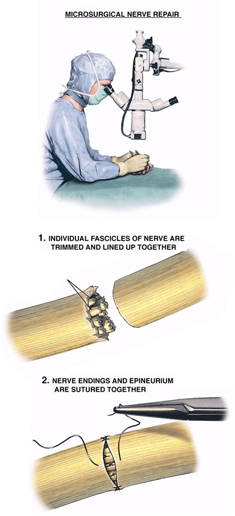The Surgical Repair Of A Nerve Medical Term