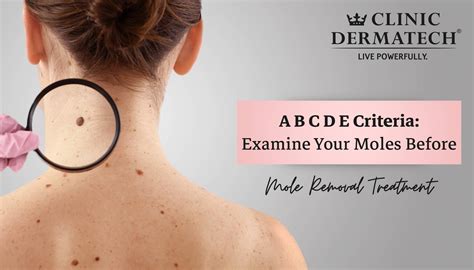 Mole Removal Journey at Douglas Nunez blog