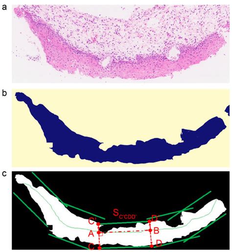 Deep Learning-Based Recognition of Cervical Squamous Interepithelial ...