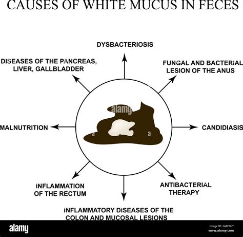 Causes of white mucus in feces. Diseases of the gastrointestinal tract. Infographics. Vector ...