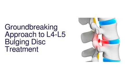 Pioneering Treatment for L4-L5 Bulging Disc Offers New Relief to Chronic Pain Patients by ...