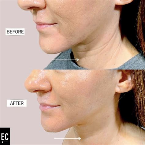 Before & After | Advanced Microcurrent Science for Anti-Aging