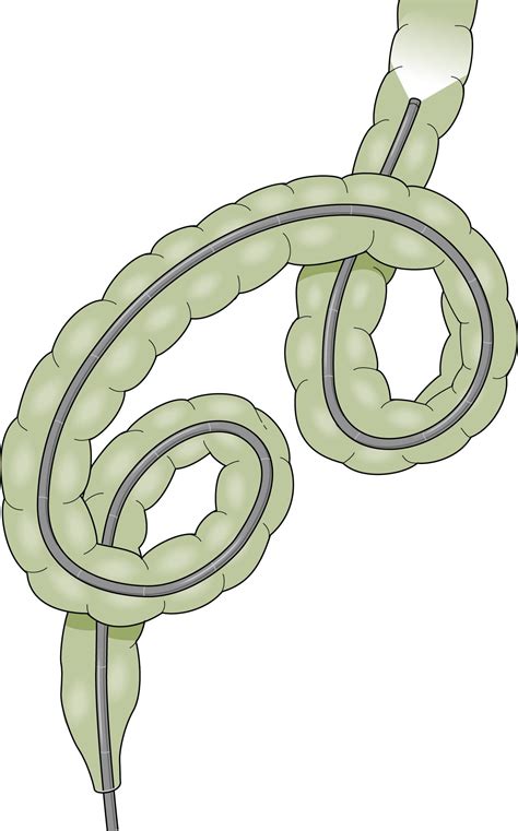 Image result for Loop Colonoscopy