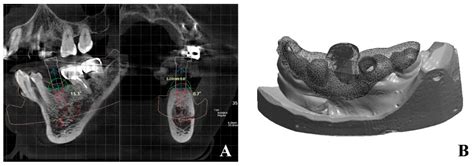 A Novel Method for Precise Guided Hole Fabrication of Dental Implant ...
