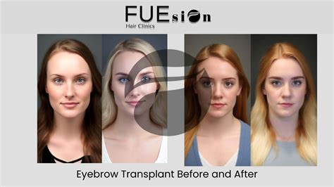 Eyebrow Transplant Before and After: Transformations and Insights