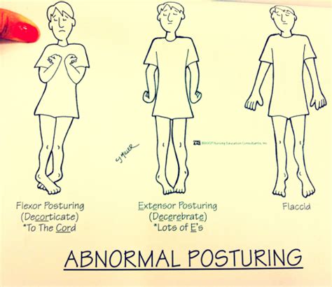 Image result for Decorticate Posture