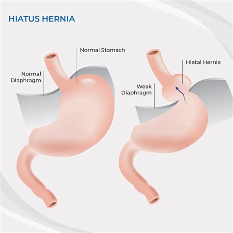 Hiatus Hernia Surgery Central Coast (Gosford & Tuggerah) | Dr Peter Hamer