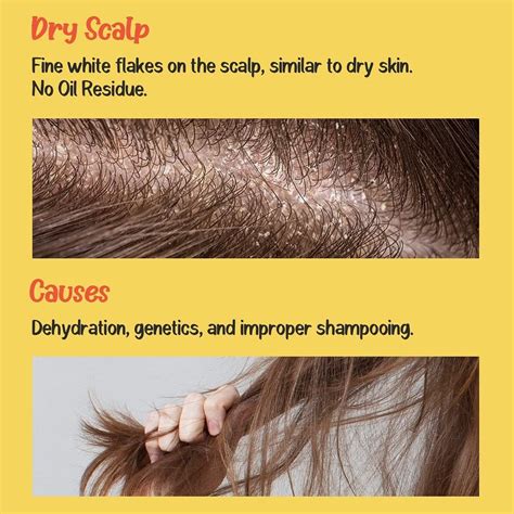 Dandruff Vs Dry Scalp