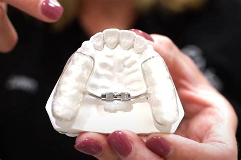 Palate Expanders for Children with Thumb and Finger Habits — Cook Orthodontics of Dublin
