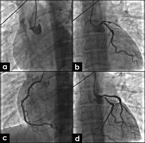 Multivessel Coronary Artery Spasm - Heart, Lung and Circulation
