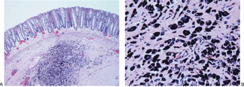 Serrated Polyps | Abdominal Key
