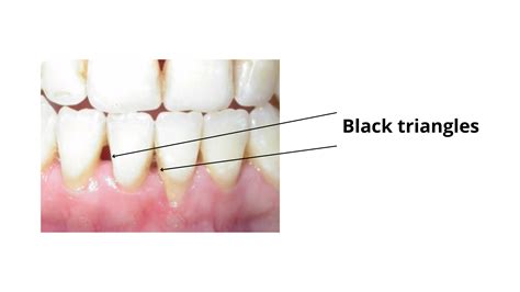 Tooth Recession 的图像结果